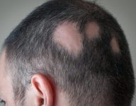 alopecia-areata-2-750x500-1